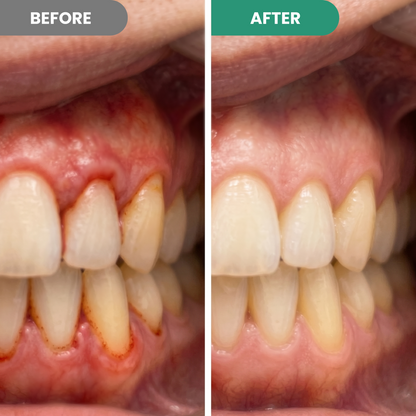 Bleeding When You Brush? Give Your Gums the Daily Support They’ve Been Missing.